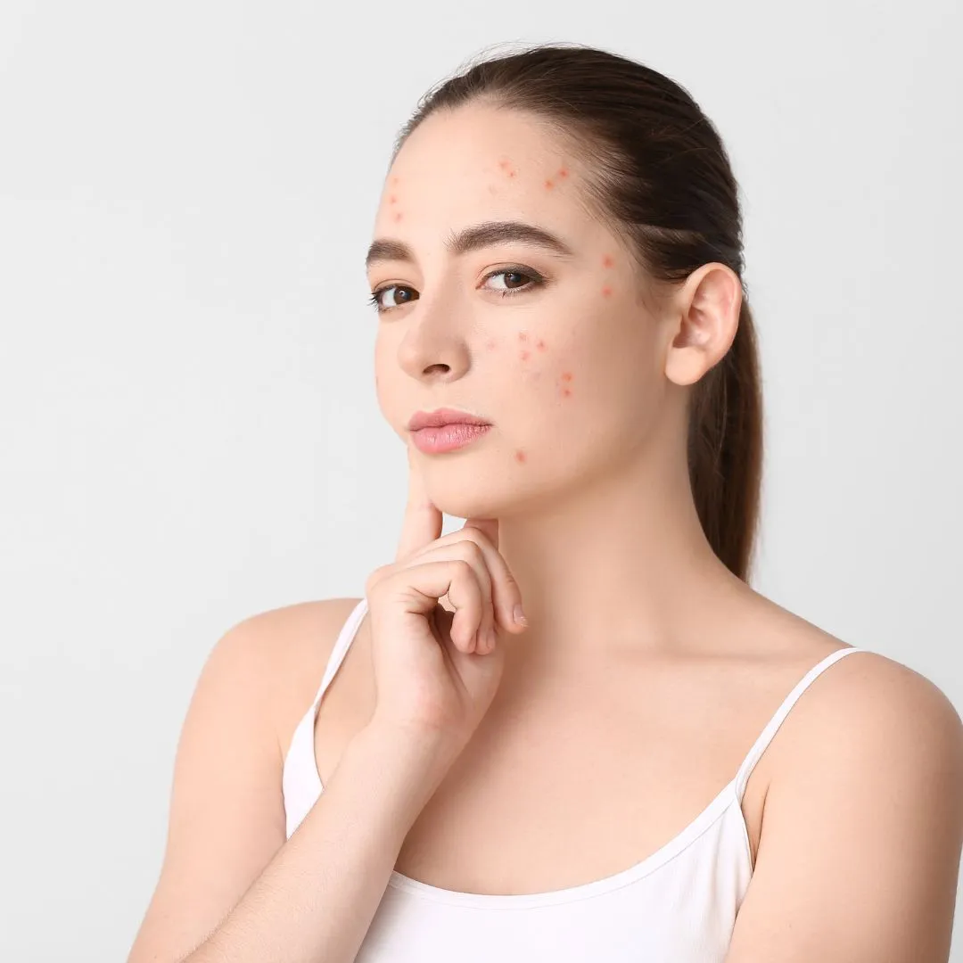 Acne Treatment solution Jaipur
