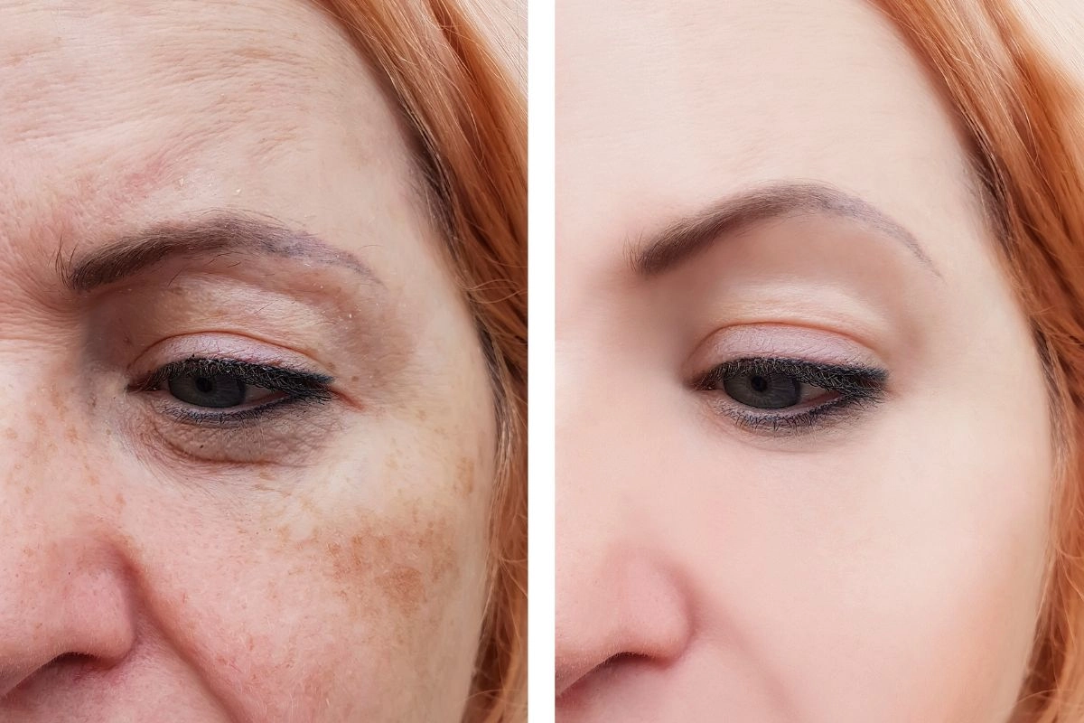 Best Skin Pigmentation in Jaipur