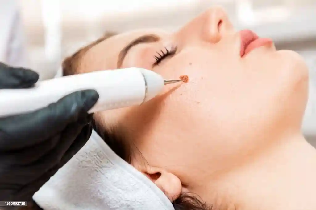 Mole Removal Treatment in Jaipur