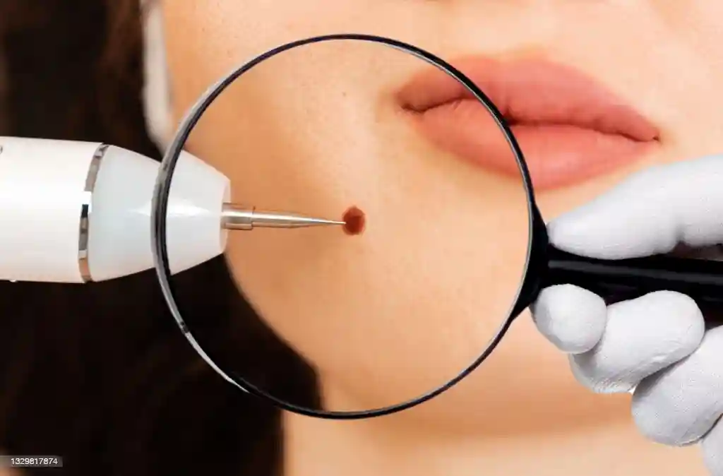 Mole Removal Treatment service in Jaipur