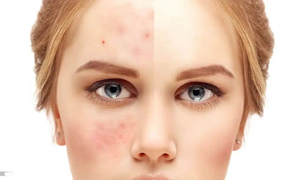Best Acne Scar Treatment in Jaipur